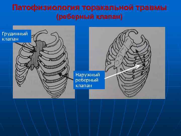 Патофизиология торакальной травмы (реберный клапан) Грудинный клапан Наружный реберный клапан 