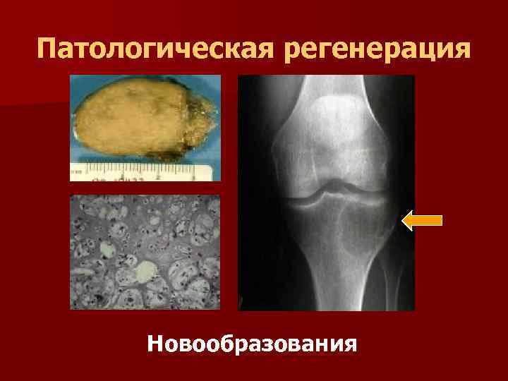 Регенерация физиологическая и патологическая презентация