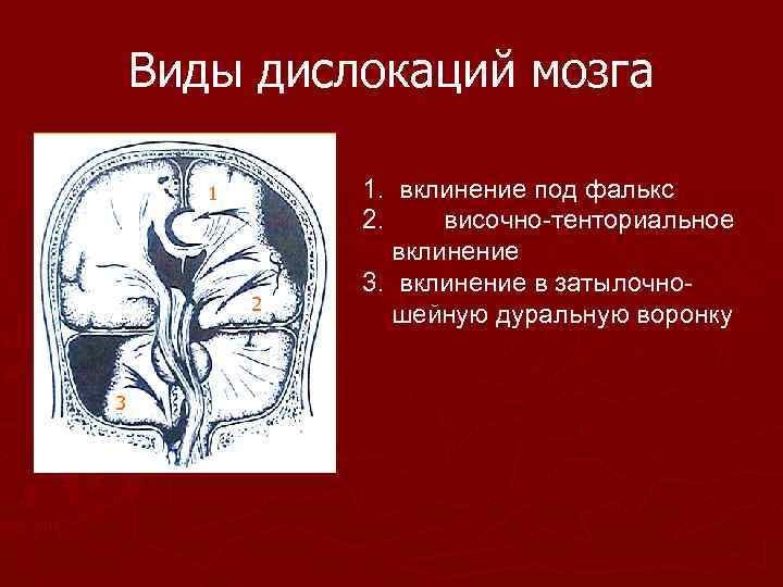 Виды дислокаций мозга 1 2 3 1. вклинение под фалькс 2. височно-тенториальное вклинение 3.