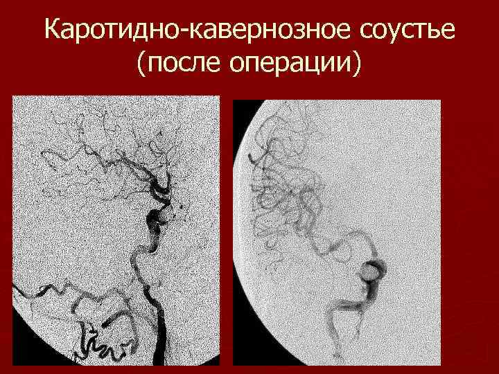 Каротидно-кавернозное соустье (после операции) 