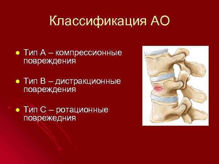 Классификация АО l Тип А – компрессионные повреждения l Тип В – дистракционные повреждения