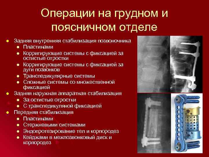 Операции на грудном и поясничном отделе l l l Задняя внутренняя стабилизация позвоночника l