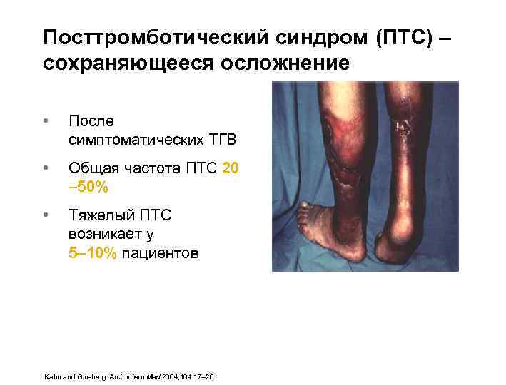 Посттромботический синдром (ПТС) – сохраняющееся осложнение • После симптоматических ТГВ • Общая частота ПТС