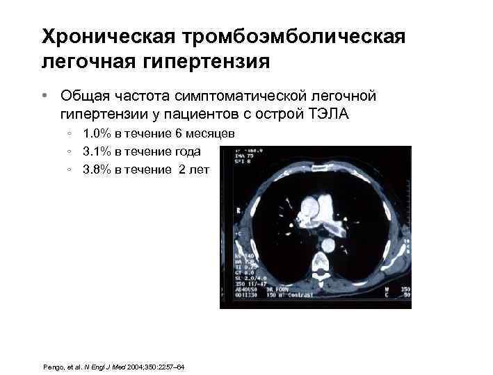 Хроническая тромбоэмболическая легочная гипертензия • Общая частота симптоматической легочной гипертензии у пациентов с острой