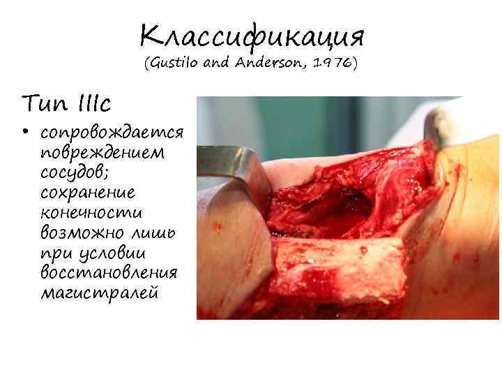 Классификация (Gustilo and Anderson, 1976) Тип IIIс • сопровождается повреждением сосудов; сохранение конечности возможно
