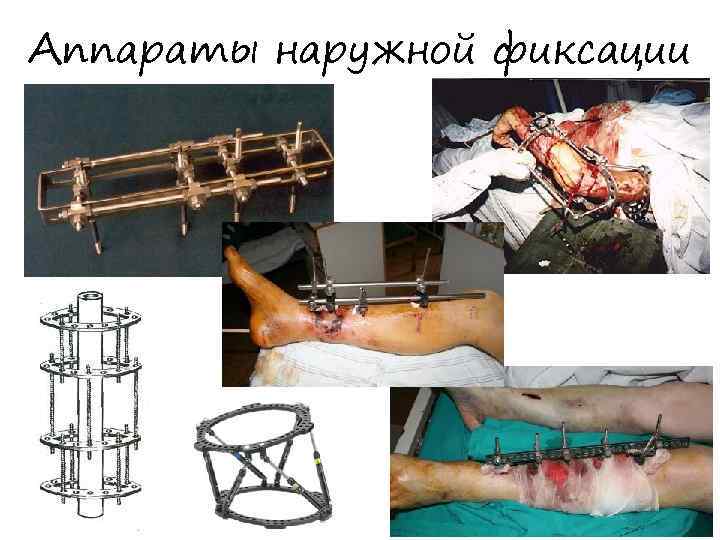Аппараты наружной фиксации 