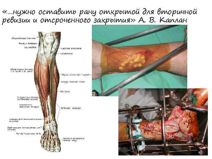 «…нужно оставить рану открытой для вторичной ревизии и отсроченного закрытия» А. В. Каплан