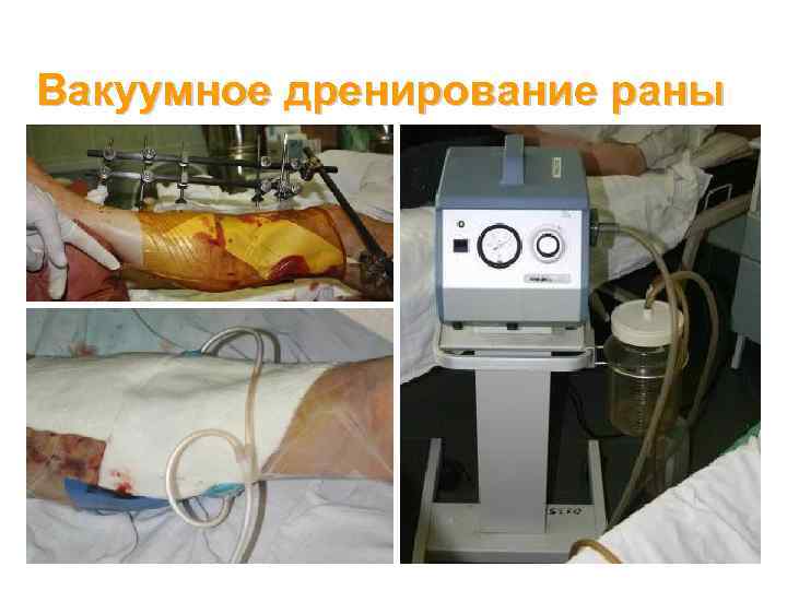 Вакуумное дренирование раны 25 