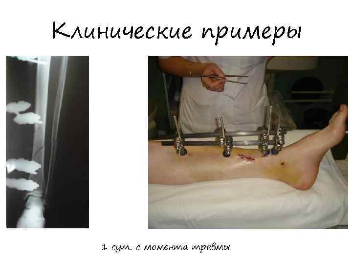 Клинические примеры 1 сут. с момента травмы 