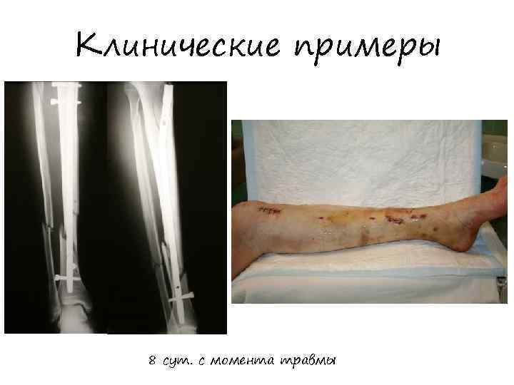 Клинические примеры 8 сут. с момента травмы 