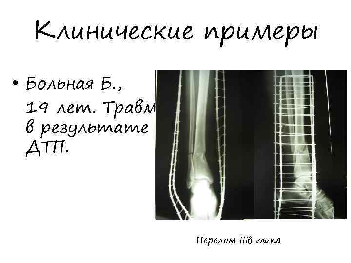 Клинические примеры • Больная Б. , 19 лет. Травма в результате ДТП. Перелом IIIв