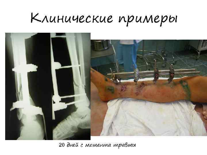Клинические примеры 20 дней с момента травмы 