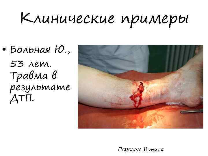 Клинические примеры • Больная Ю. , 53 лет. Травма в результате ДТП. Перелом II