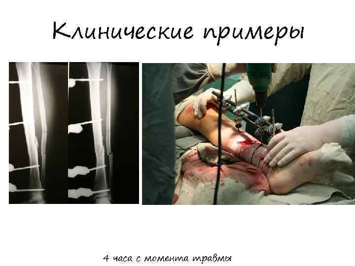 Клинические примеры 4 часа с момента травмы 