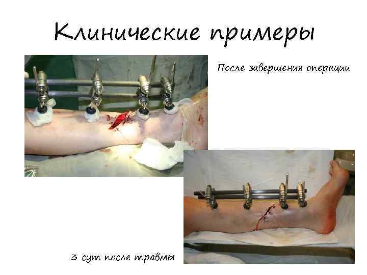 Клинические примеры После завершения операции 3 сут после травмы 
