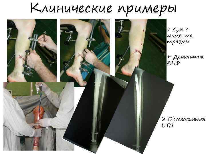Клинические примеры 7 сут с момента травмы Ø Демонтаж АНФ Ø Остеосинтез UTN 