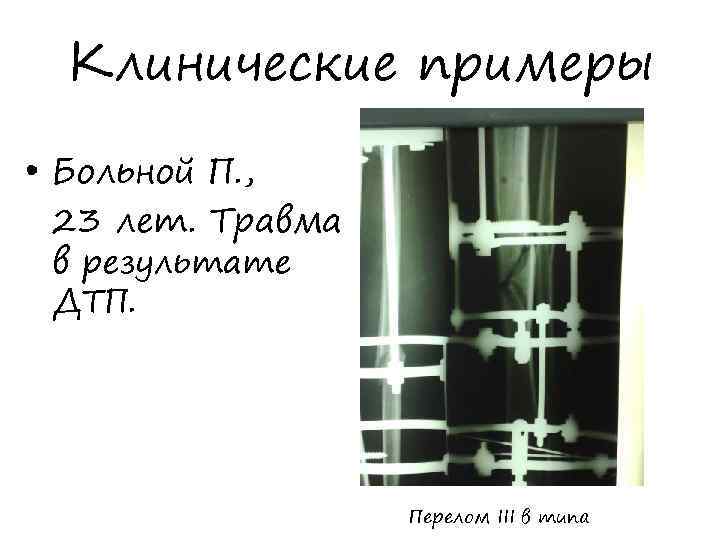 Клинические примеры • Больной П. , 23 лет. Травма в результате ДТП. Перелом III