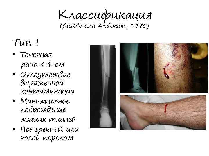 Классификация (Gustilo and Anderson, 1976) Тип I • Точечная рана < 1 см •
