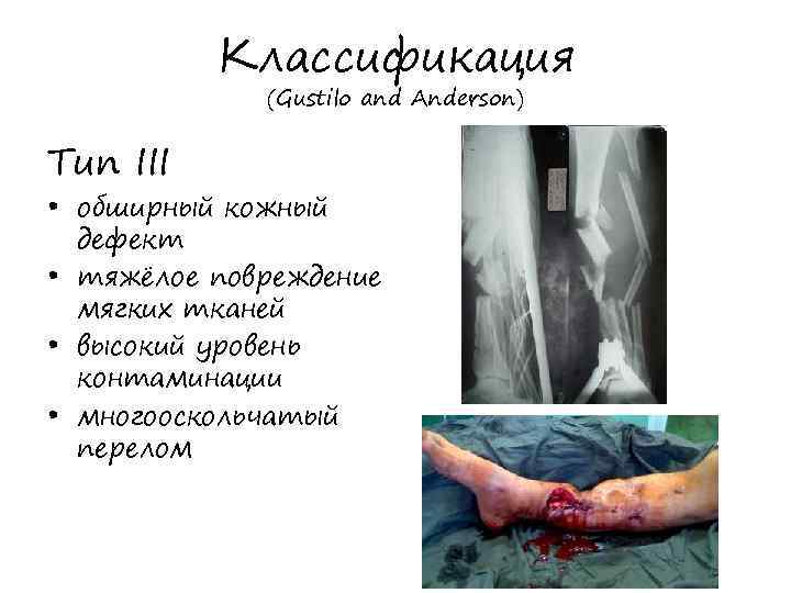 Классификация (Gustilo and Anderson) Тип III • обширный кожный дефект • тяжёлое повреждение мягких