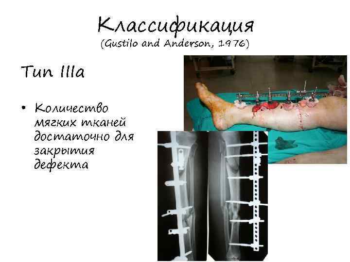 Классификация (Gustilo and Anderson, 1976) Тип IIIа • Количество мягких тканей достаточно для закрытия