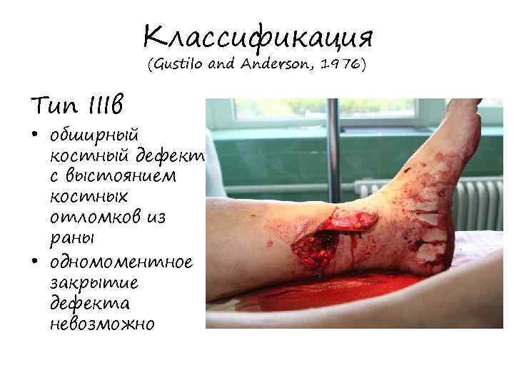 Классификация (Gustilo and Anderson, 1976) Тип IIIв • обширный костный дефект с выстоянием костных