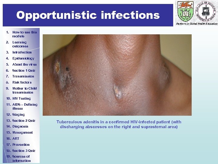 Opportunistic infections Partners in Global Health Education 1. How to use this module 2.