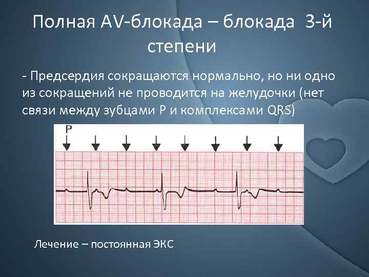 Полная АV-блокада – блокада 3 -й степени - Предсердия сокращаются нормально, но ни одно
