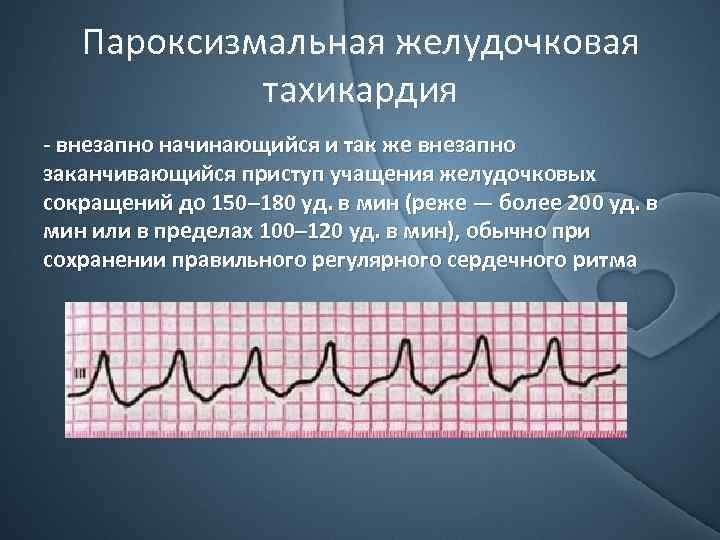 Пароксизмальная желудочковая тахикардия - внезапно начинающийся и так же внезапно заканчивающийся приступ учащения желудочковых