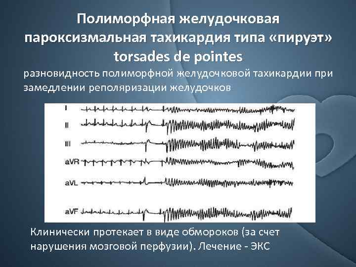 Полиморфная желудочковая пароксизмальная тахикардия типа «пируэт» torsades de pointes разновидность полиморфной желудочковой тахикардии при
