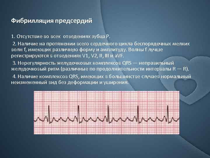 Фибрилляция предсердий 1. Отсутствие во всех отведениях зубца Р. 2. Наличие на протяжении всего