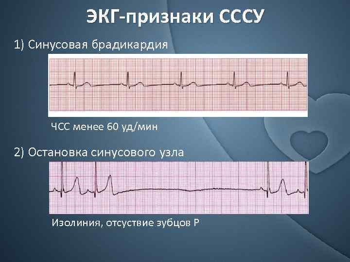 ЭКГ-признаки СССУ 1) Синусовая брадикардия ЧСС менее 60 уд/мин 2) Остановка синусового узла Изолиния,