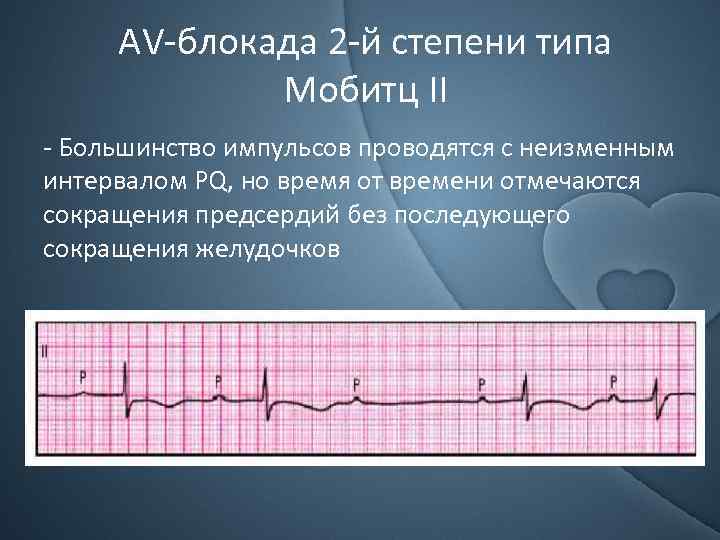 АV-блокада 2 -й степени типа Мобитц II - Большинство импульсов проводятся с неизменным интервалом