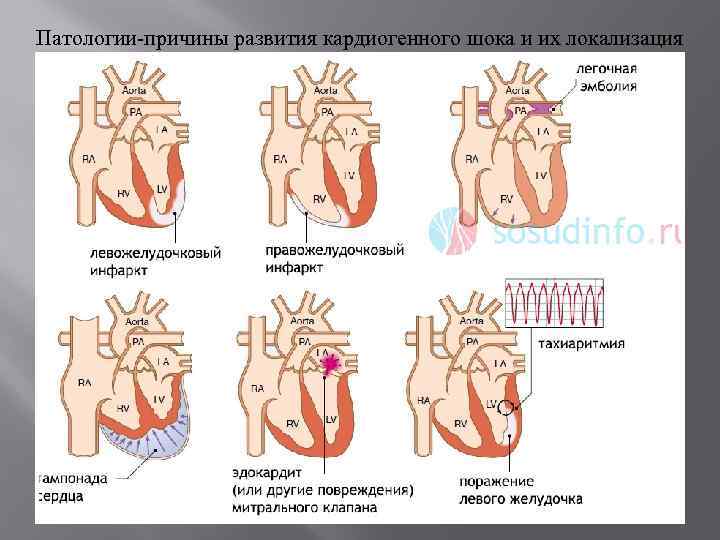 Патологии-причины развития кардиогенного шока и их локализация 