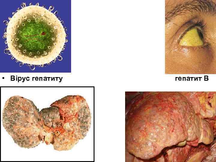  • Вірус гепатиту гепатит В 