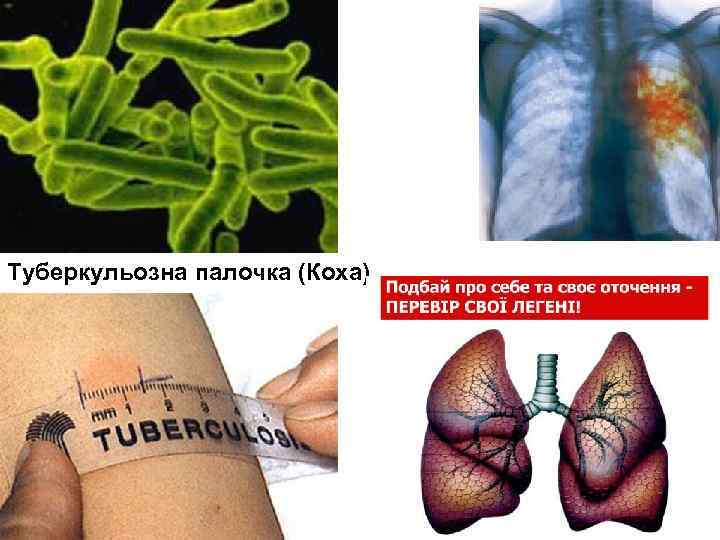 Туберкульозна палочка (Коха) 