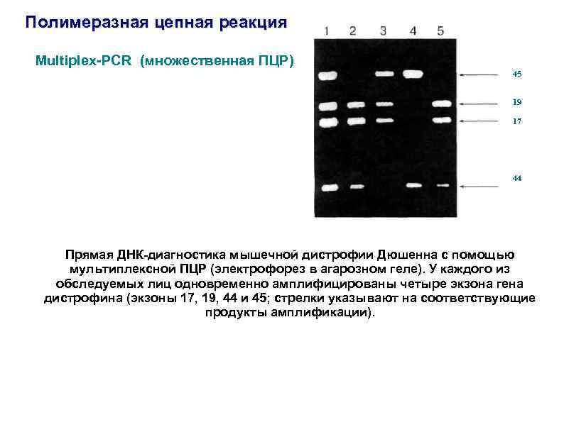 Полимеразная цепная реакция Multiplex-PCR (множественная ПЦР) 45 19 17 44 Прямая ДНК-диагностика мышечной дистрофии