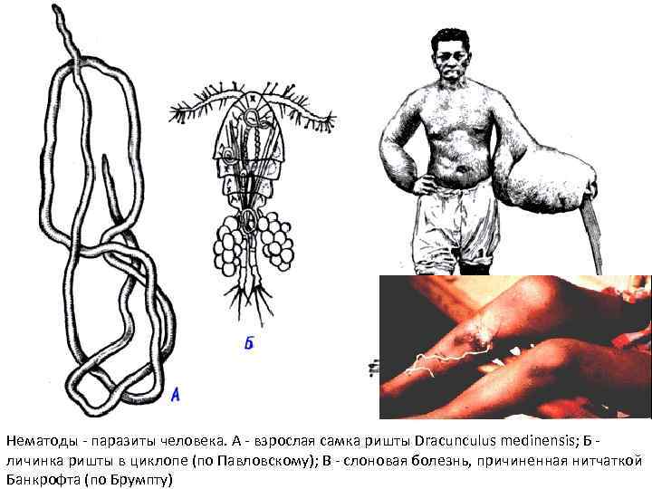 Нематоды - паразиты человека. А - взрослая самка ришты Dracunculus medinensis; Б личинка ришты