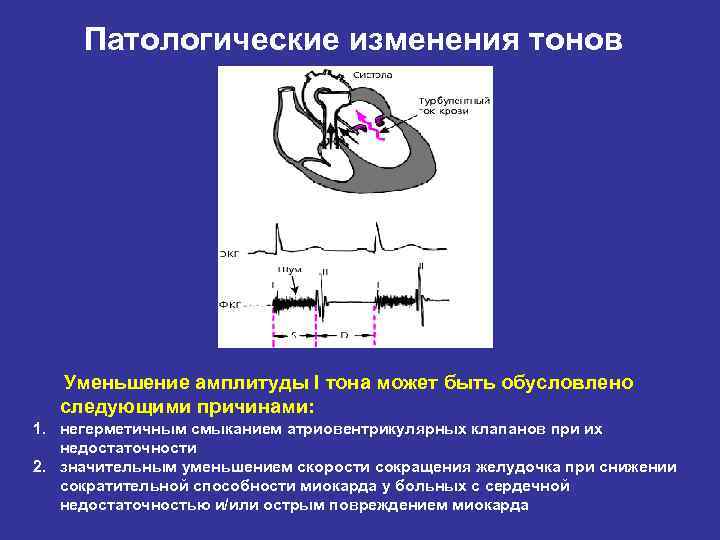 Патологические изменения тонов Уменьшение амплитуды I тона может быть обусловлено следующими причинами: 1. негерметичным