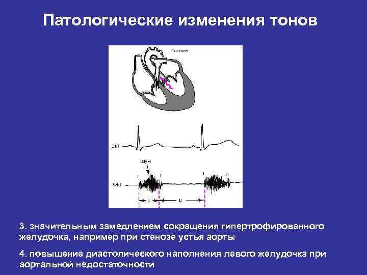 Патологические изменения тонов 3. значительным замедлением сокращения гипертрофированного желудочка, например при стенозе устья аорты