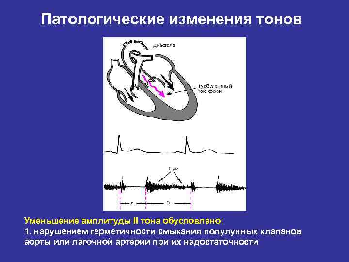 Патологические изменения тонов Уменьшение амплитуды II тона обусловлено: 1. нарушением герметичности смыкания полулунных клапанов