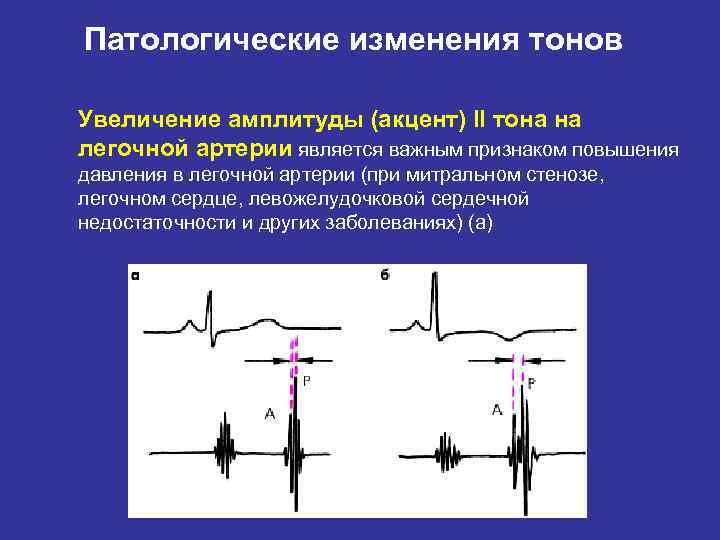 Тоны сердца акцент 2 тона