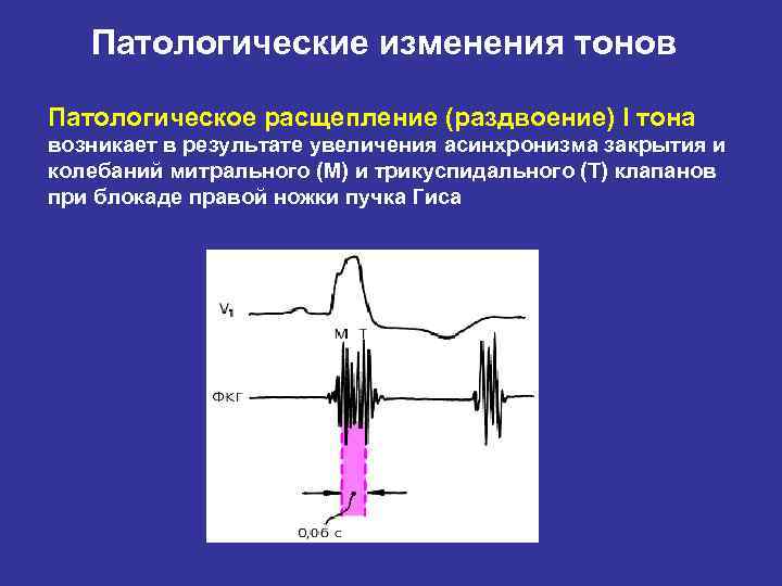 Патологические изменения тонов Патологическое расщепление (раздвоение) I тона возникает в результате увеличения асинхронизма закрытия