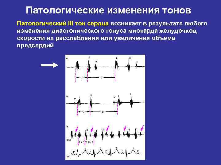 Графическое изображение тонов сердца