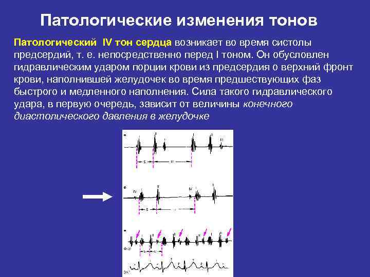 Тону сердца приглушенные. Патологические изменения тонов сердца. Патологический 3 тон сердца. Аускультативные изменения тонов сердца. Физиологическое и патологическое изменение тонов сердца.