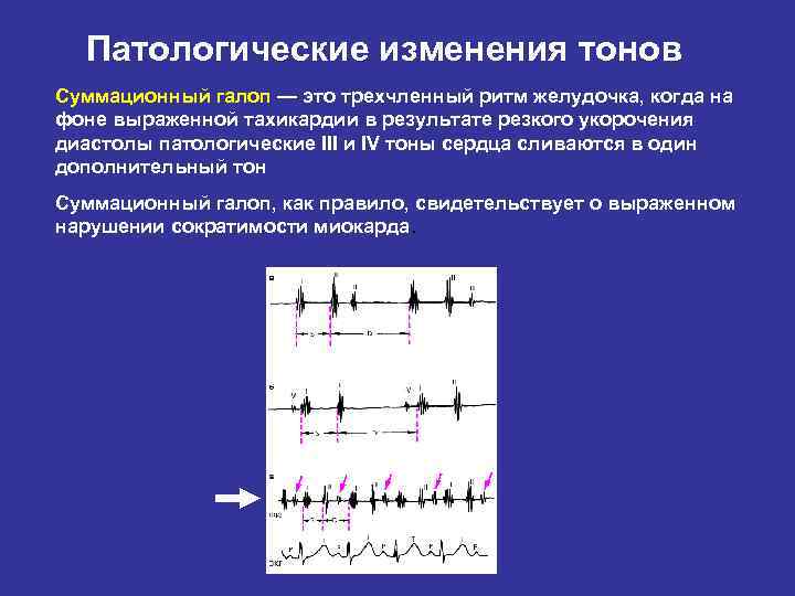 Ритм галопа при каком заболевании