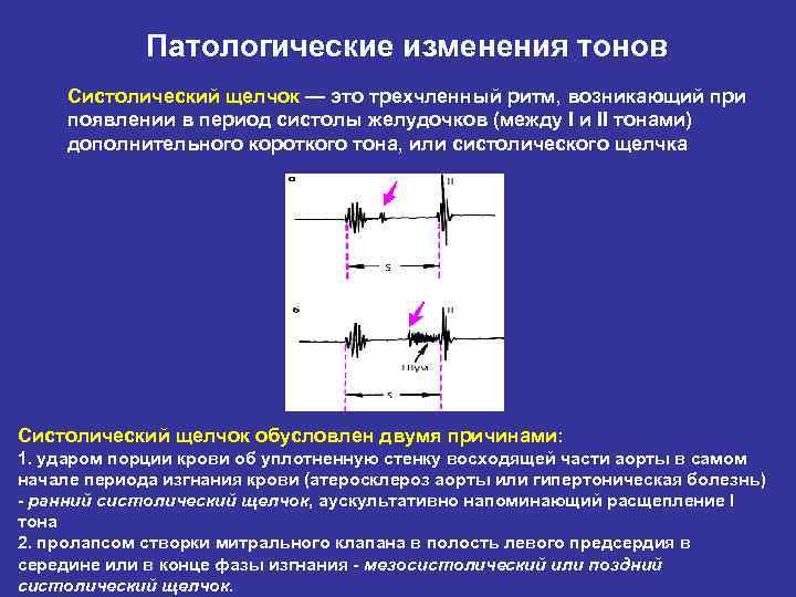 Патологические изменения тонов Систолический щелчок — это трехчленный ритм, возникающий при появлении в период