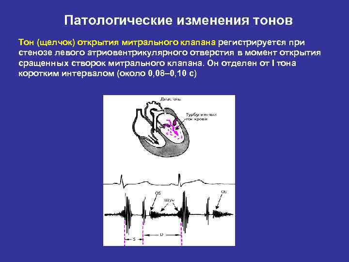 Патологические изменения тонов Тон (щелчок) открытия митрального клапана регистрируется при стенозе левого атриовентрикулярного отверстия