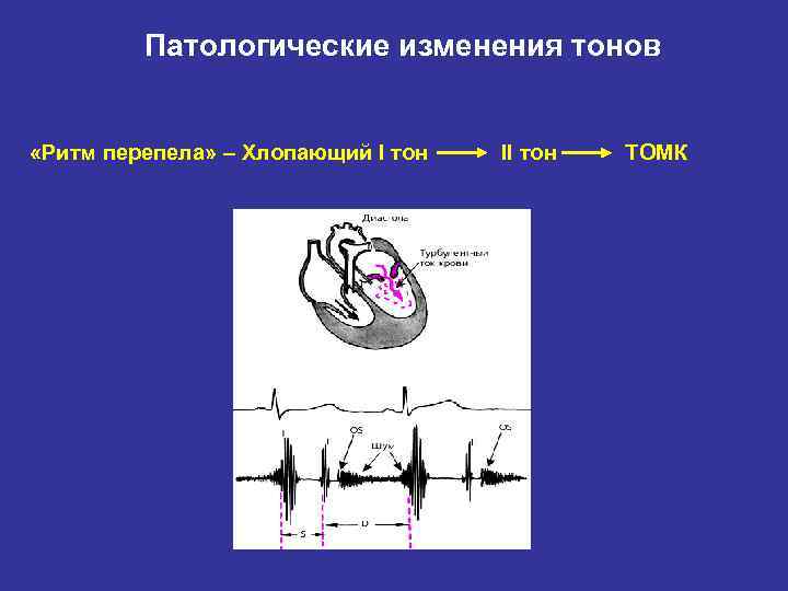 Патологические изменения тонов «Ритм перепела» – Хлопающий I тон II тон ТОМК 