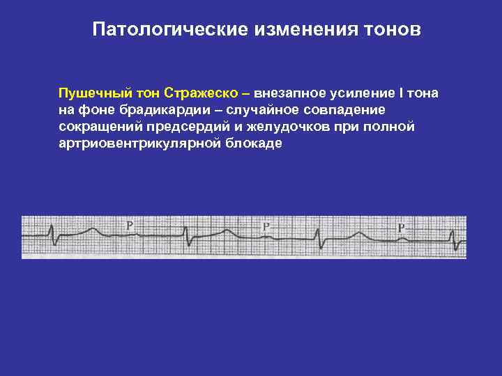 Патологические изменения тонов Пушечный тон Стражеско – внезапное усиление I тона на фоне брадикардии