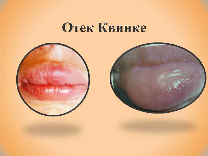 Отек Квинке 